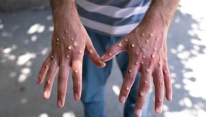 mpox